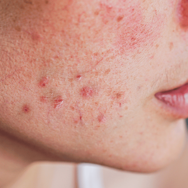 Moitié inférieure du visage d'une femme présentant de l'acné et des imperfections sur fond clair.