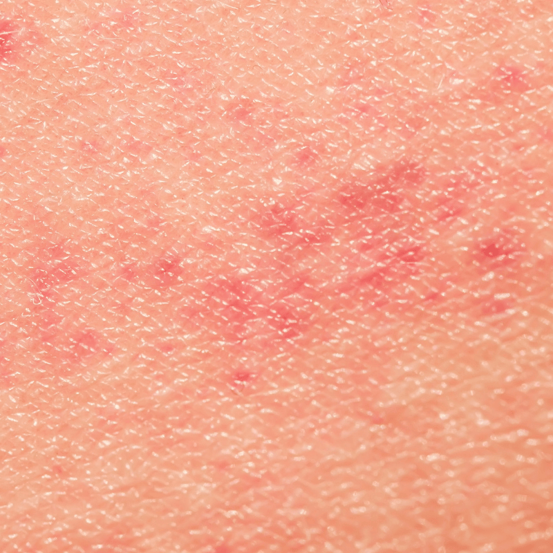 Gros plan d'une peau de visage inflammatoire présentant des rougeurs.