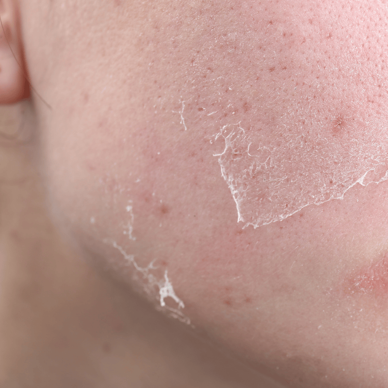 Gros plan sur la joue d'une personne dont la peau est sèche et squameuse. La texture est rugueuse, ressemblant à la peau sèche classique, et les squames semblent se détacher par plaques. Le teint est clair, le contraste blanc des squames mettant en évidence son état délicat.